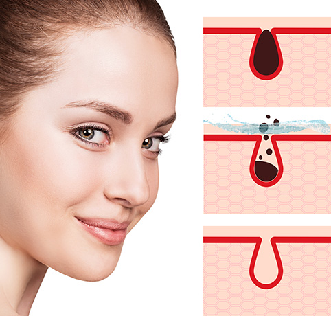 春の肌トラブル 毛穴の開き シンシアガーデンクリニック高崎院