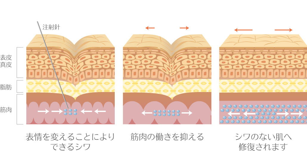 群馬県高崎･太田・伊勢崎の表情ジワ・小じわ改善｜ボトックスシワ取りボトックス表情ジワ・小じわ改善botulinum toxin injection