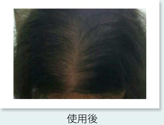 ヘアーフィラー 薄毛治療ならシンシアガーデンクリニック高崎院 ヘアーフィラー 薄毛治療ならシンシアガーデンクリニック高崎院